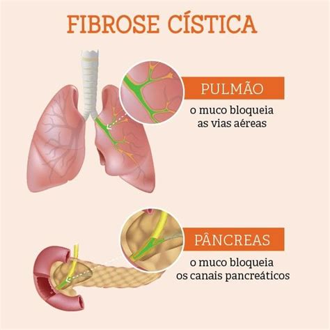 fibrose cistica sintomas